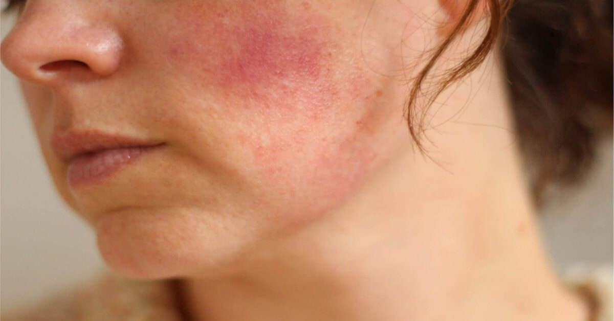 Mẹo chăm sóc da mặt bị dị ứng đơn giản hiệu quả tại nhà